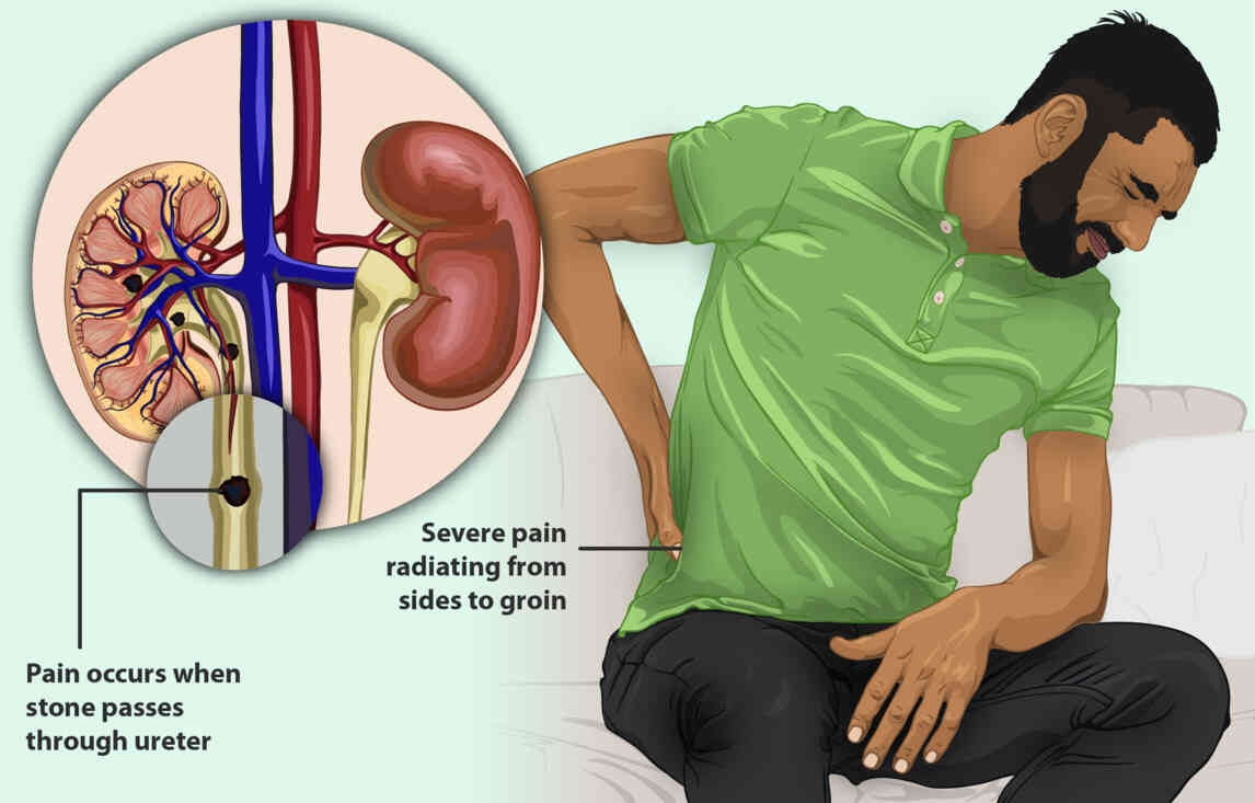 Timing is Key: Optimal Duration for Using Heating Pads for Kidney Stone Pain